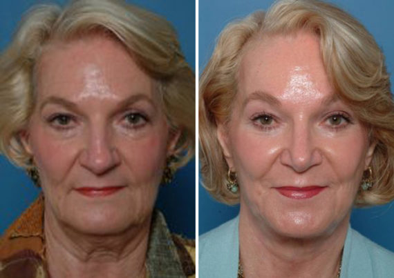 Endoscopic Facelift Before and After Photos in Naples, FL, Patient 8396