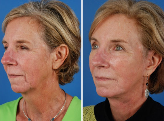 Endoscopic Facelift Before and After Photos in Naples, FL, Patient 8401