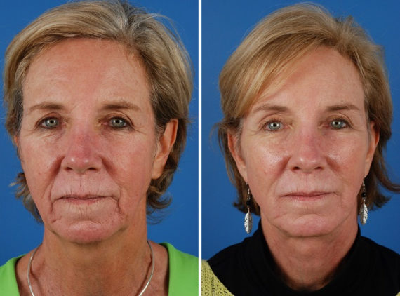 Endoscopic Facelift Before and After Photos in Naples, FL, Patient 8401