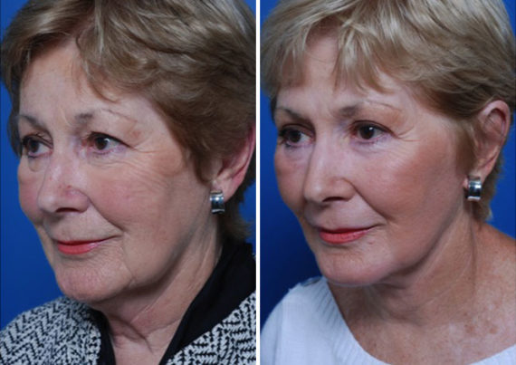 Endoscopic Facelift Before and After Photos in Naples, FL, Patient 8406