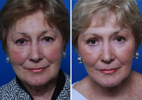 Endoscopic Facelift Before and After Photos in Naples, FL, Patient 8406