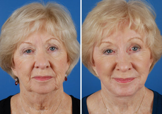 Endoscopic Facelift Before and After Photos in Naples, FL, Patient 8413
