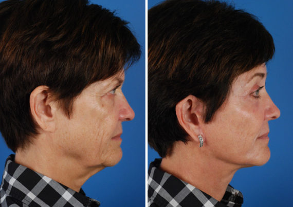 Endoscopic Facelift Before and After Photos in Naples, FL, Patient 8422