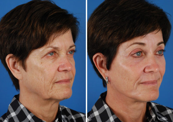 Endoscopic Facelift Before and After Photos in Naples, FL, Patient 8422