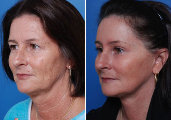 Endoscopic Facelift Before and After Photos in Naples, FL, Patient 8429