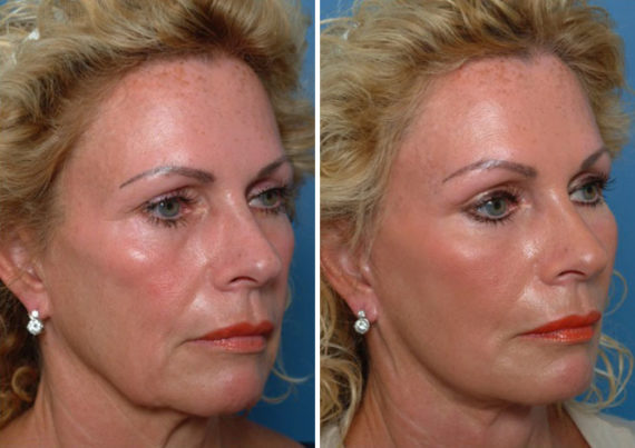 Endoscopic Facelift Before and After Photos in Naples, FL, Patient 8432
