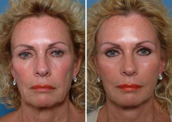 Endoscopic Facelift Before and After Photos in Naples, FL, Patient 8432
