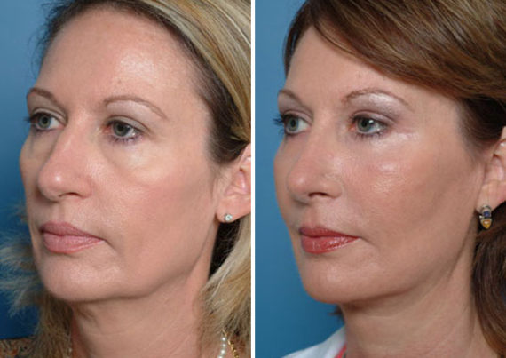 Endoscopic Facelift Before and After Photos in Naples, FL, Patient 8437