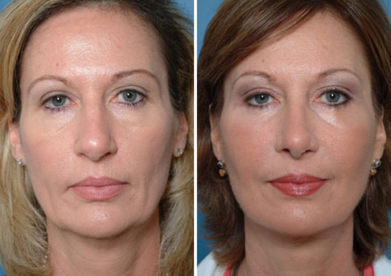 Endoscopic Facelift Before and After Photos in Naples, FL, Patient 8437