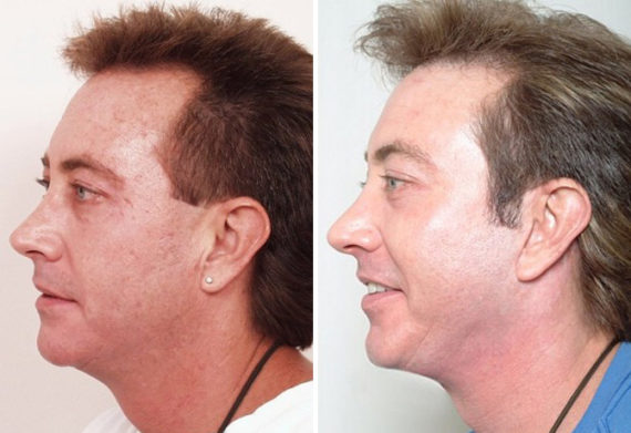 Endoscopic Facelift Before and After Photos in Naples, FL, Patient 8444