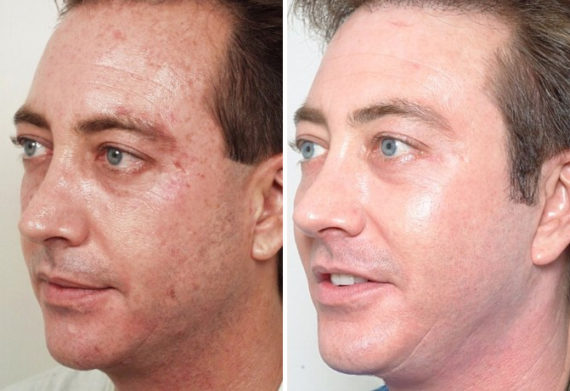 Endoscopic Facelift Before and After Photos in Naples, FL, Patient 8444