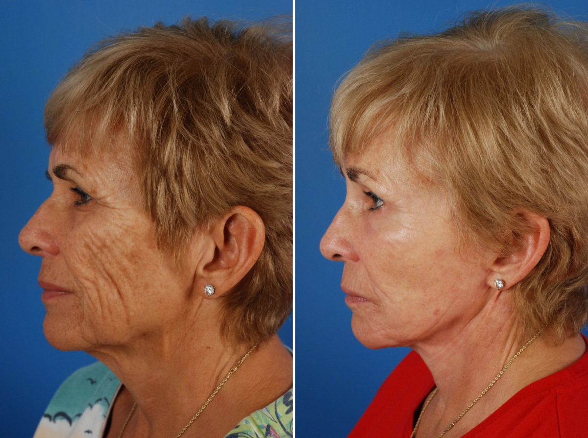 Endoscopic Facelift Before and After Photos in Naples, FL, Patient 8456