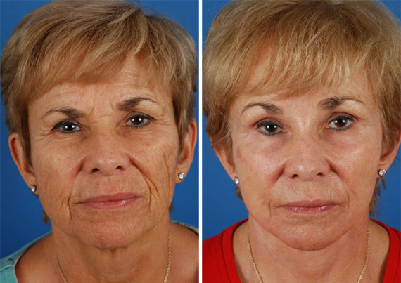 Endoscopic Facelift Before and After Photos in Naples, FL, Patient 8456