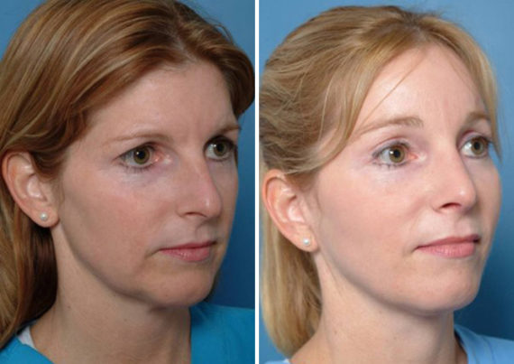 Eyebrow & Forehead Before and After Photos in Naples, FL, Patient 8470