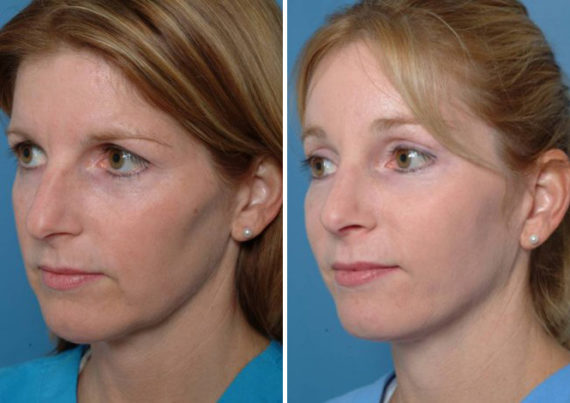 Eyebrow & Forehead Before and After Photos in Naples, FL, Patient 8470
