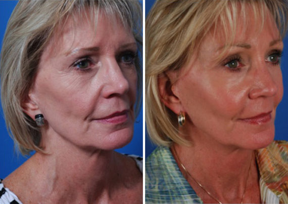 Eyebrow & Forehead Before and After Photos in Naples, FL, Patient 8475