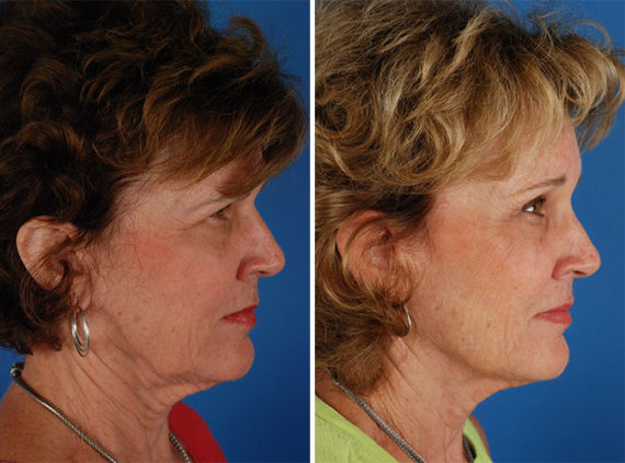 Eyebrow & Forehead Before and After Photos in Naples, FL, Patient 8487