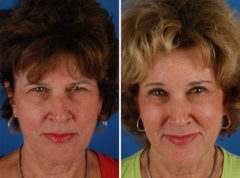 Eyebrow & Forehead Before and After Photos in Naples, FL, Patient 8487