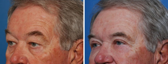 Fat Transfer Before and After Photos in Naples, FL, Patient 8503