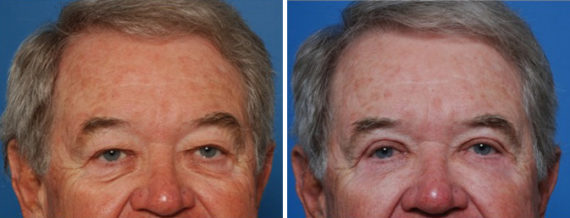 Fat Transfer Before and After Photos in Naples, FL, Patient 8503