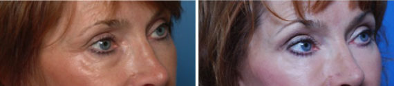 Fat Transfer Before and After Photos in Naples, FL, Patient 8508