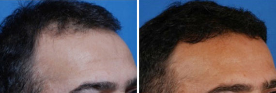 Hair Replacement Before and After Photos in Naples, FL, Patient 8523