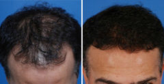 Hair Replacement Before and After Photos in Naples, FL, Patient 8523