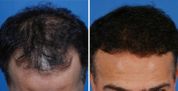 Hair Replacement Before and After Photos in Naples, FL, Patient 8523