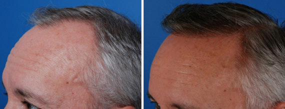 Hair Replacement Before and After Photos in Naples, FL, Patient 8530
