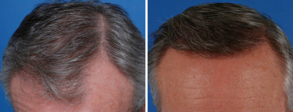 Hair Replacement Before and After Photos in Naples, FL, Patient 8530