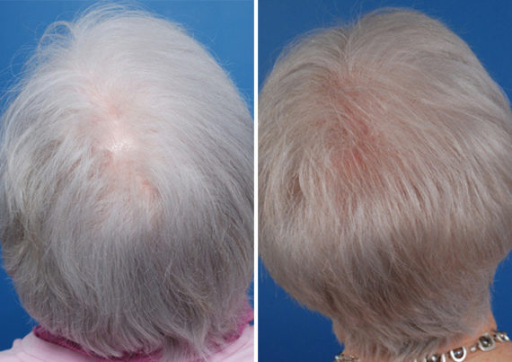 Hair Replacement Before and After Photos in Naples, FL, Patient 8535