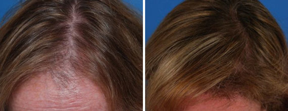 Hair Replacement Before and After Photos in Naples, FL, Patient 8538