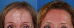 Hair Replacement Before and After Photos in Naples, FL, Patient 8538