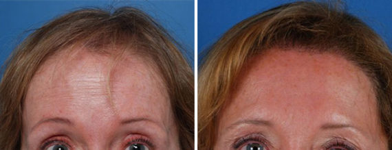 Hair Replacement Before and After Photos in Naples, FL, Patient 8538