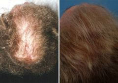 Hair Replacement Before and After Photos in Naples, FL, Patient 8543