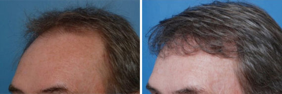 Hair Replacement Male Before and After Photos in Naples, FL, Patient 8551