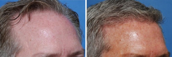 Hair Replacement Before and After Photos in Naples, FL, Patient 8554