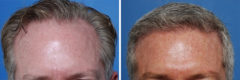 Hair Replacement Before and After Photos in Naples, FL, Patient 8554