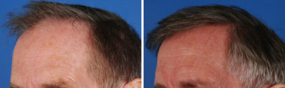 Hair Replacement Before and After Photos in Naples, FL, Patient 8559