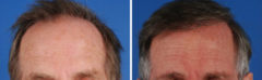 Hair Replacement Before and After Photos in Naples, FL, Patient 8559