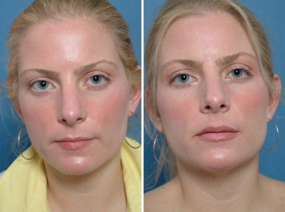 Lip Enhancement Before and After Photos in Naples, FL, Patient 8564