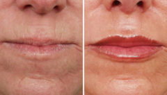 Lip Enhancement Before and After Photos in Naples, FL, Patient 8567