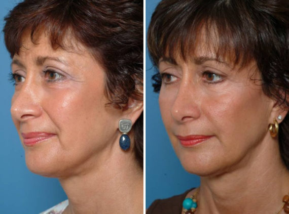 Injectable Fillers Before and After Photos in Naples, FL, Patient 8590