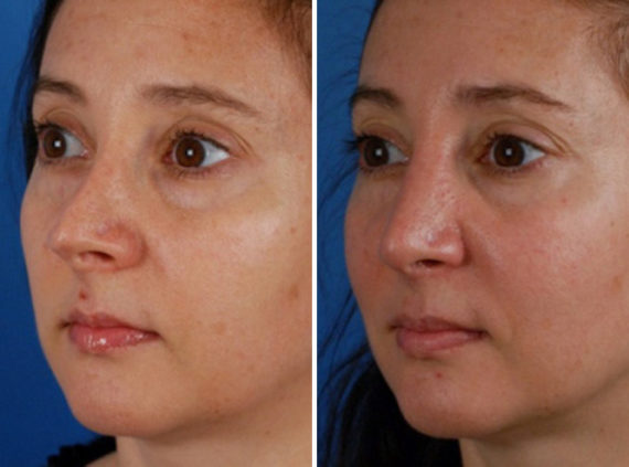 Revision Rhinoplasty Before and After Photos in Naples, FL, Patient 8593