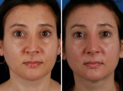 Revision Rhinoplasty Before and After Photos in Naples, FL, Patient 8593