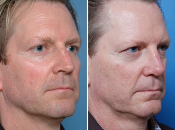 Revision Rhinoplasty Before and After Photos in Naples, FL, Patient 8605