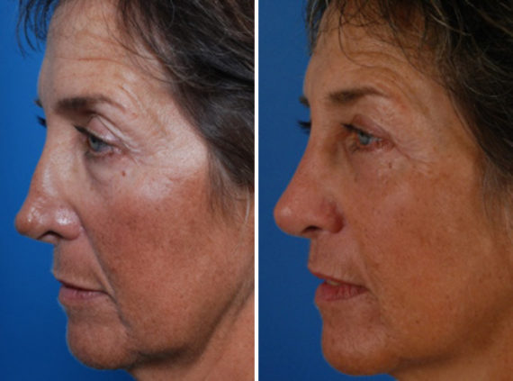 Revision Rhinoplasty Before and After Photos in Naples, FL, Patient 8612