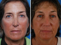 Revision Rhinoplasty Before and After Photos in Naples, FL, Patient 8612