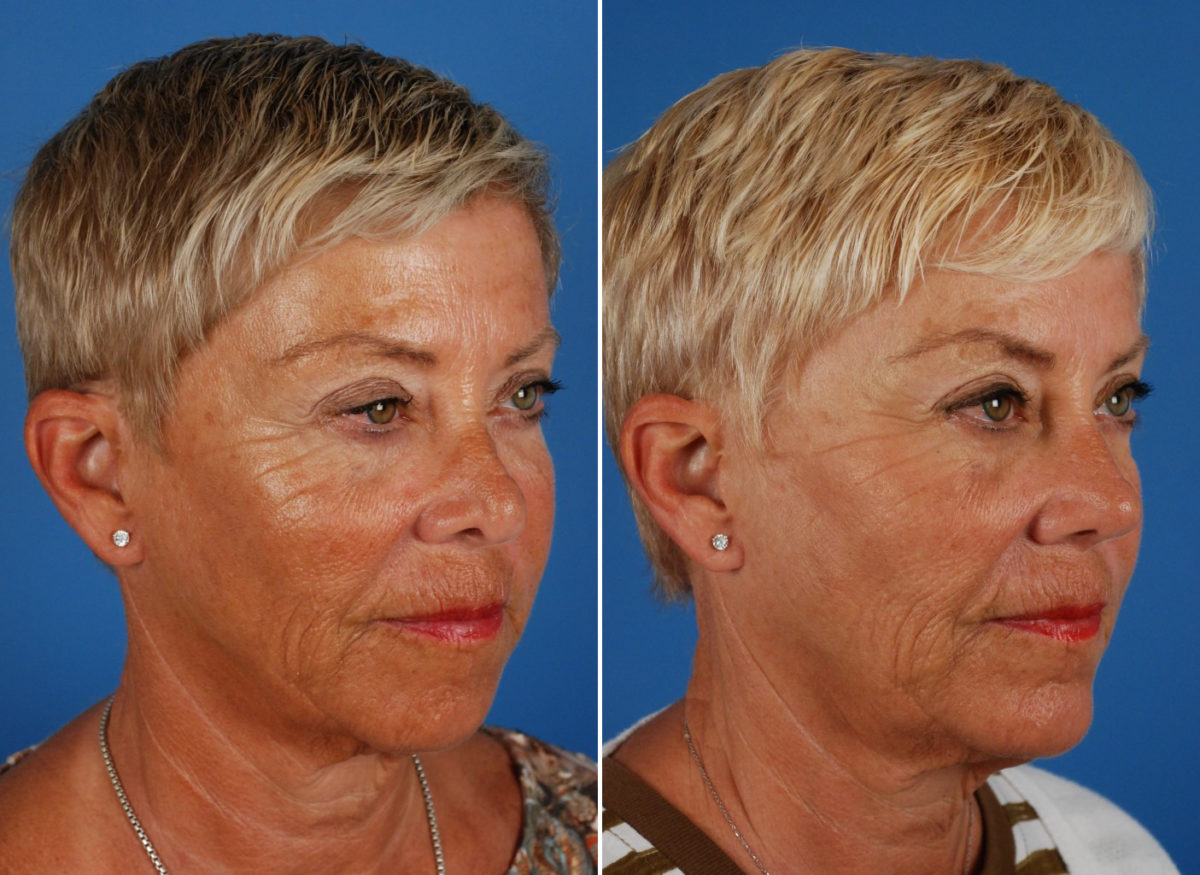 Revision Rhinoplasty Before and After Photos in Naples, FL, Patient 8619