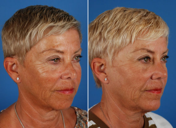 Revision Rhinoplasty Before and After Photos in Naples, FL, Patient 8619